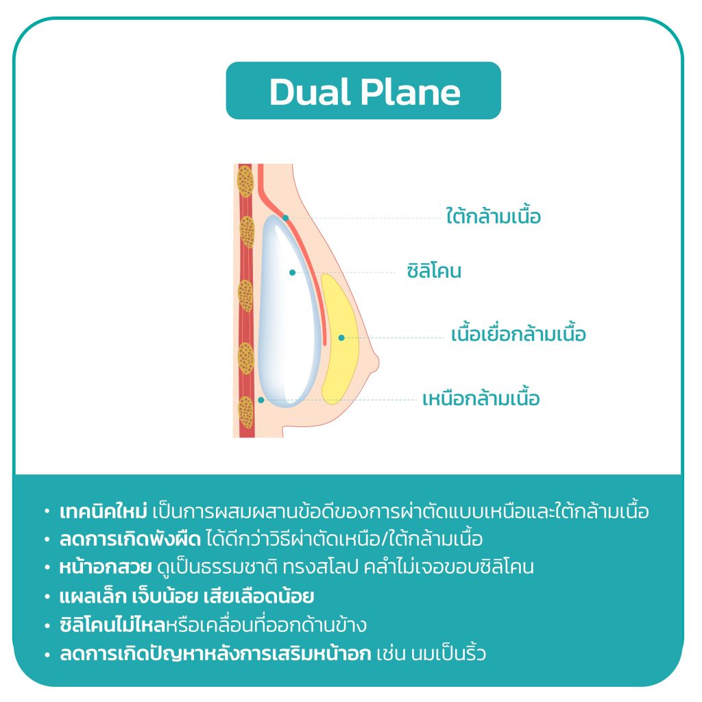 เสริมหน้าอก เทคนิค Dual plane เสริมซิลิโคนระหว่างชั้นกล้ามเนื้อ