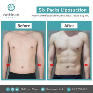 รีวิวดูดไขมันซิกแพค six pack