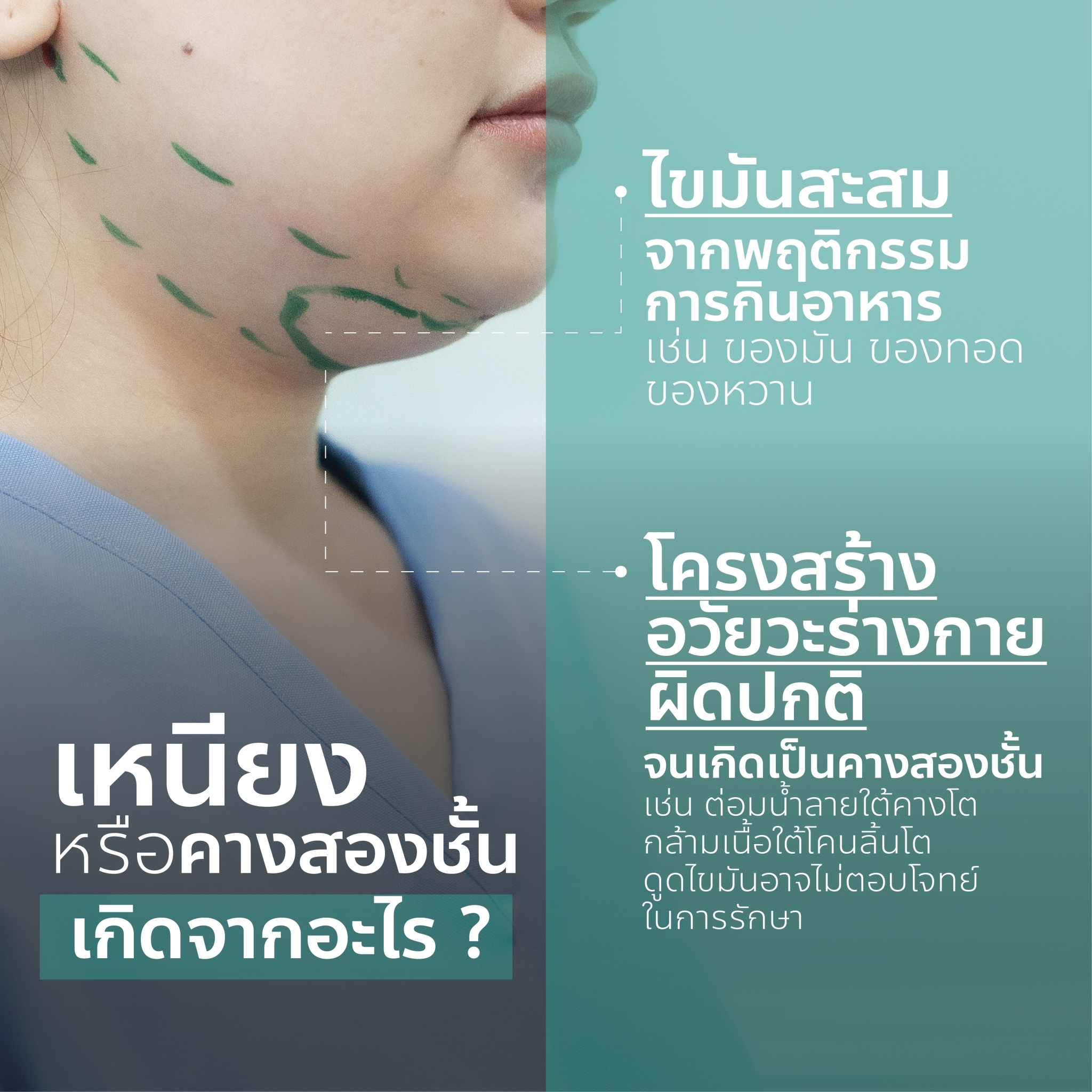 เหนียง เกิดจากอะไร