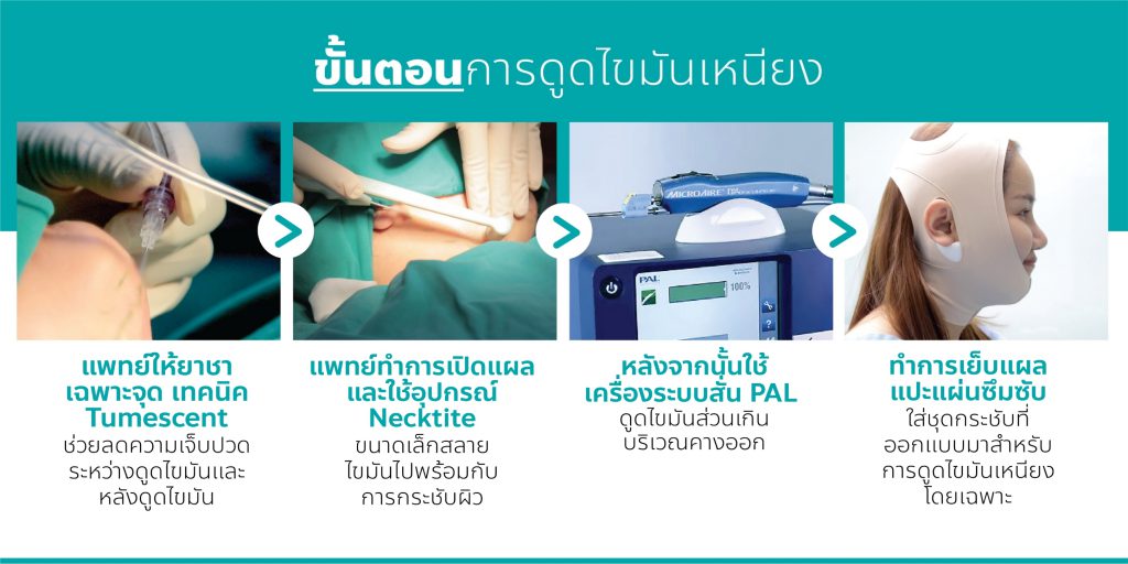 ขั้นตอนการดูดไขมันเหนียง