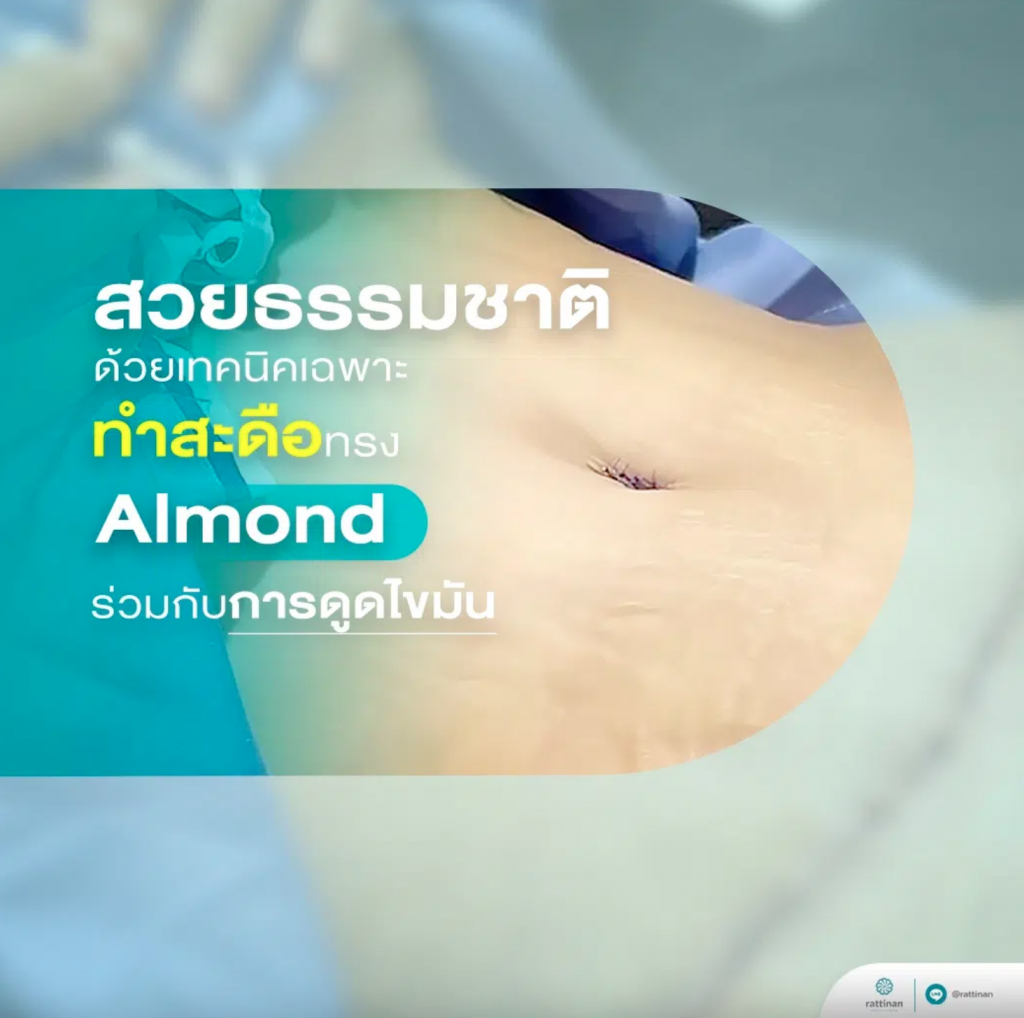 ตัดแต่งสะดือทรง Almond Shape