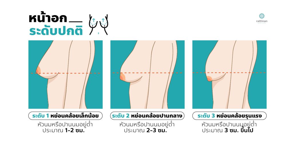 ผ่าตัดยกกระชับหน้าอก ระดับความหย่อนคล้อยหน้าอก