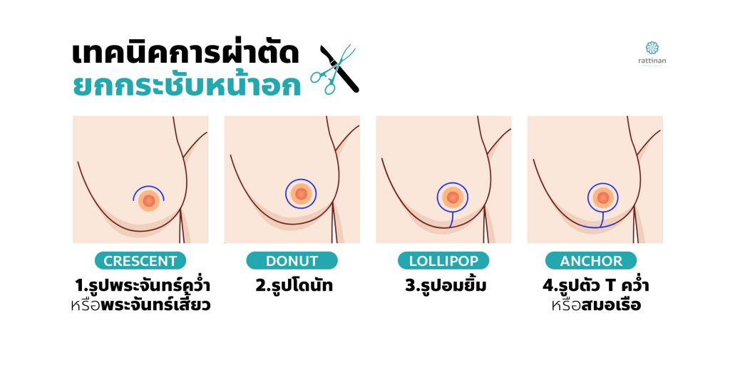 ศัลยกรรม ยกกระชับหน้าอก มีกี่วิธี