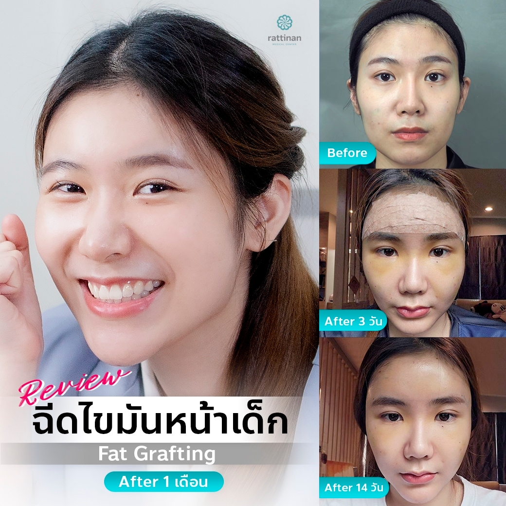 รีวิวเติมไขมันหน้า fat grafting