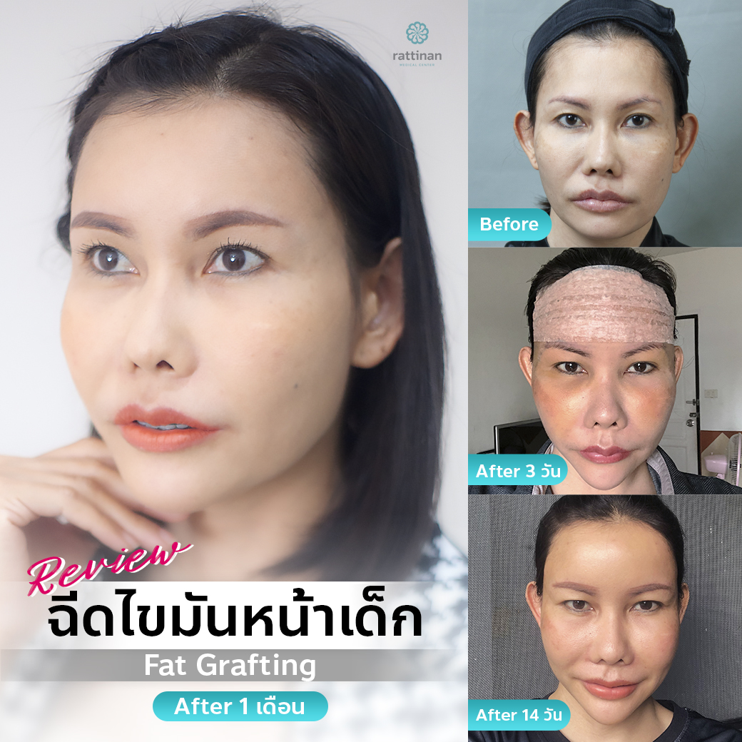 รีวิวเติมไขมันหน้า fat grafting