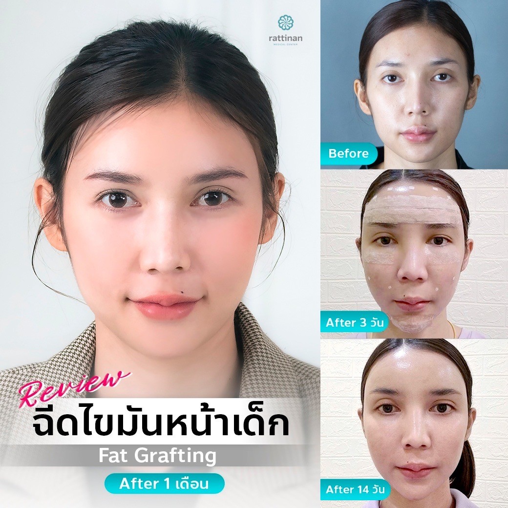 รีวิวเติมไขมันหน้า fat grafting