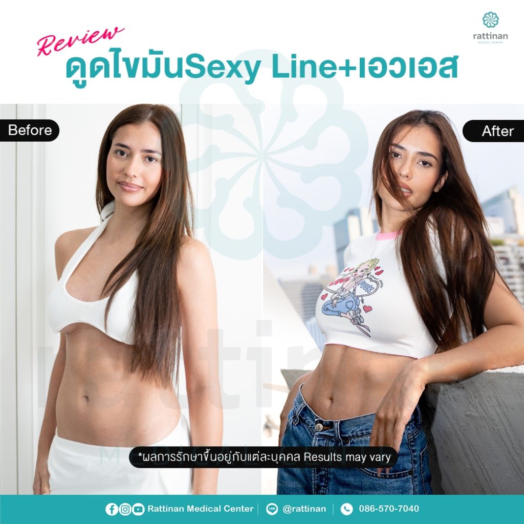 แอนโทเนีย โพซิ้ว ดูดไขมัน Sexy Line