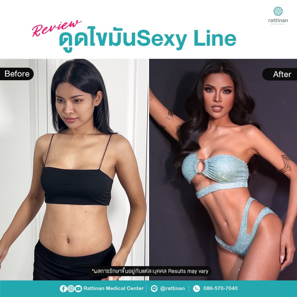 มิน วรวลัญช์ พุฒกลาง. MUT Uttaradit 2023 รีวิวดูดไขมัน sexy line สร้างกล้ามหน้าท้อง ร่อง 11