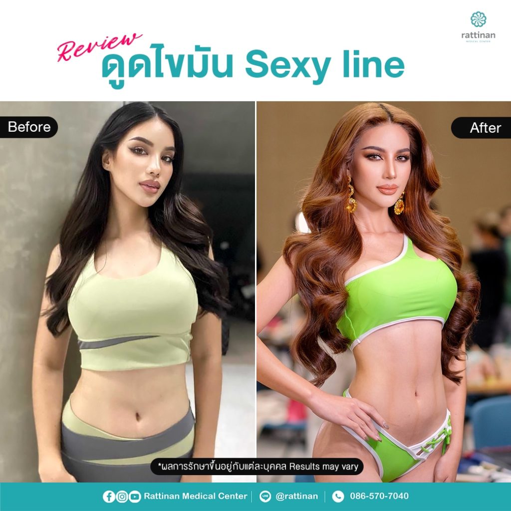 คณา คณาพร พัฒนพันธ์ มิสแกรนด์สุรินทร์ 2023 รีวิวดูดไขมัน sexy line