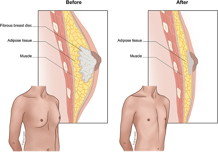 Gynecomastia or men boobs